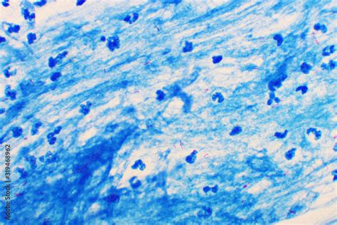 Mycobacterium Tuberculosis Positive Small Red Rod In Sputum Smear