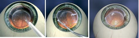 Implantable Collamer Lenses ICLs Precision Eye MD