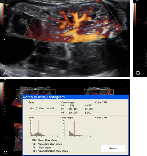 Figure 1 From Quantitative Evaluation Of Renal Arteries Using Three