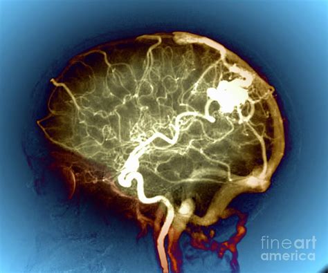 Cerebral Arteriovenous Malformation Photograph By Zephyrscience Photo Library Fine Art America