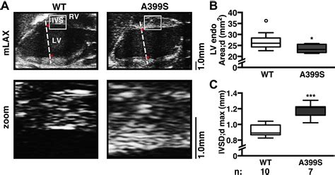 Novel Junctophilin 2 Mutation A405s Is Associated With Basal Septal