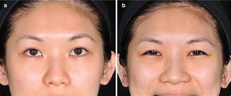 Flat Nasal Bridge And Epicanthal Folds - Flat Nasal Bridge And Epicanthal Folds - Down Syndrome ...