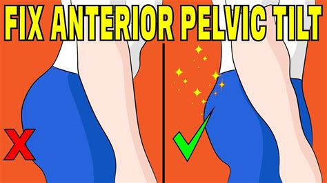 How To Fix Anterior Pelvic Tilt Without Any Equipment The Natural