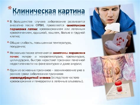 Презентация Синдром Гудпасчера