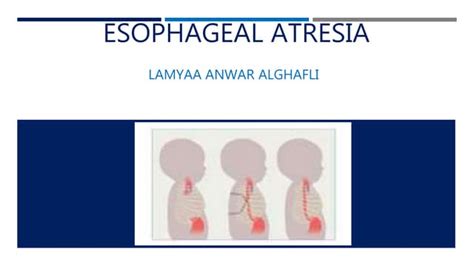 Esophageal Atresia Ppt