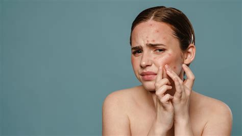 Winter acne breakouts: Causes and 11 tips to deal with it | HealthShots