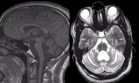 Cerebellar Ataxia - Inherited or Acquired: Causes, Symptoms and Treatments - Scope Heal