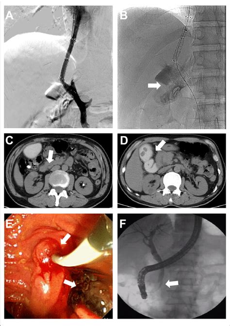 Characteristics And Management Of Hemobilia A B Bile Duct Was