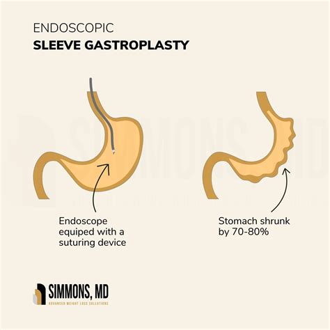 Endoscopic Sleeve Gastroplasty Miami ESG For Weight Loss