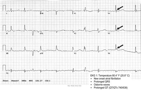 Hypothermia Ecg