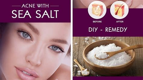 How To Treat Acne With Sea Salt