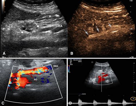 Improved visualization of the SMA with contrast-enhanced ultrasound... | Download Scientific Diagram