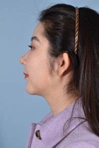 Chin Implant Archives Chevy Chase Md Capital Facial Plastic Surgery