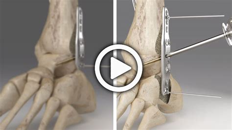 OsteoMed ExtremiLock Ankle Fusion Plates System Overview Acumed