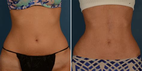 VASER Liposuction Photos Naples FL Patient 23209