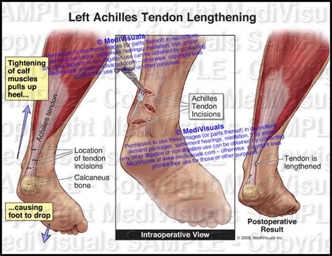 Achilles Tendon Lengthening Medivisuals Inc