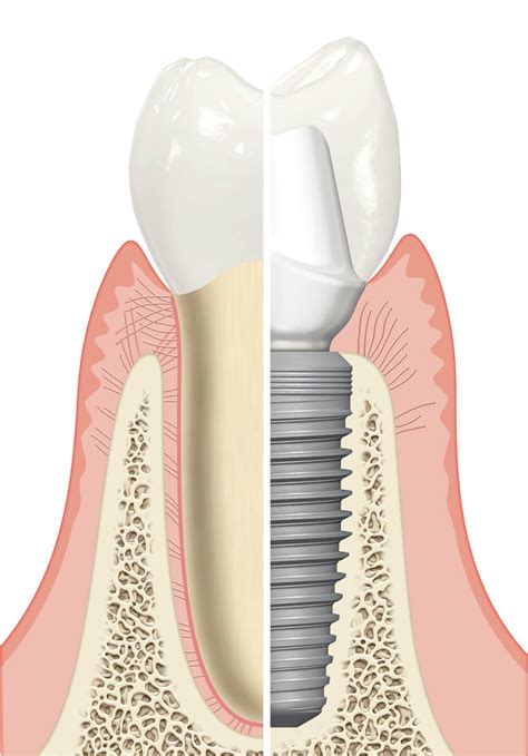 One Visit Dental Crown Napier Dental Implants Hawkes Bay