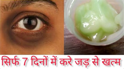 How To Remove Dark Circles Naturally In 7 Days 100 Result Jaina