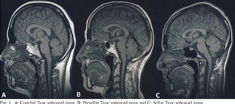 Sphenoid Sinus Anatomy