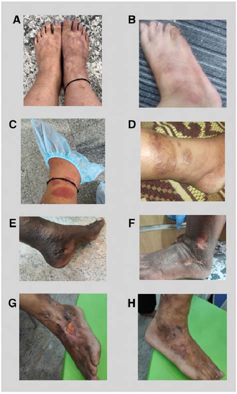 Comparison Of Cutaneous Pan Ulcers Skin Lesions Before And After