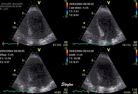 Stress Echocardiogram