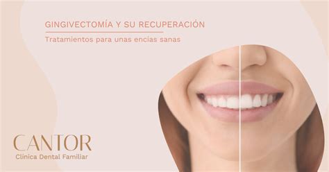 Gingivectomía y su recuperación consejos Clínica Cantor