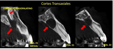 Caso N Quiste Nasopalatino Cdi