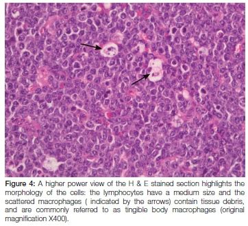 Oral Medicine Case Book Burkitt Lymphoma Of The Oral Cavity