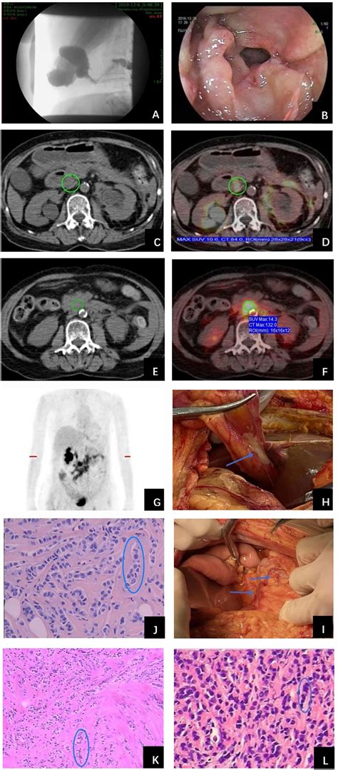 Frontiers Peritoneal Metastasis After Treated With Abemaciclib Plus