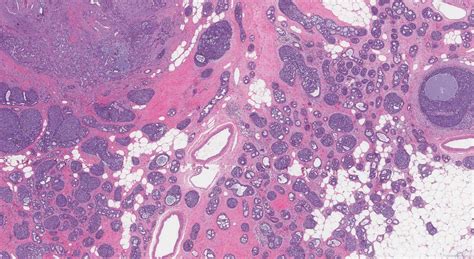 Adenoid Cystic Carcinoma Of The Breast Atlas Of Pathology