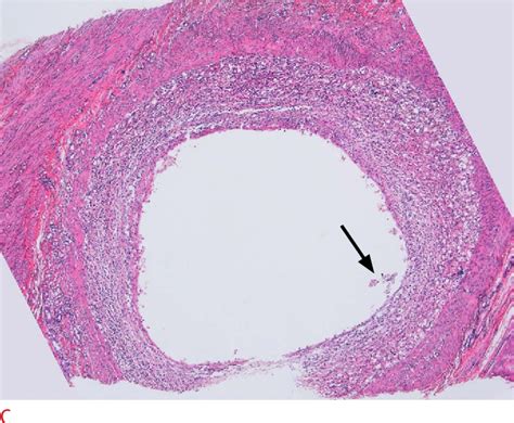 Figure From Differential Diagnosis Of Umbilical Polyps And Granulomas