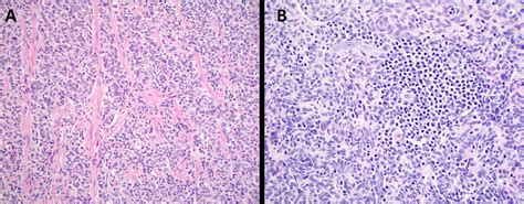 Uterine Tumor Resembling Ovarian Sex Cord Tumor Utrosct A