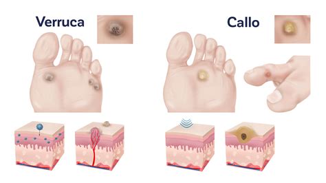Calli Ai Piedi Sintomi E Trattamento Italia
