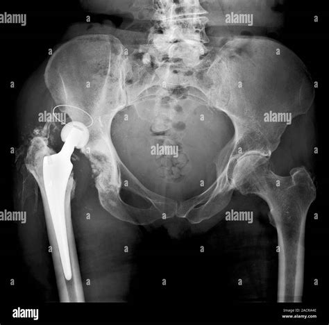 Dislocated Hip Replacement X Ray Of The Pelvis Of A Patient Who S