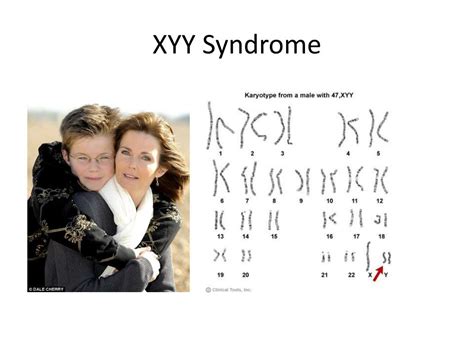 Ppt Human Sex Chromosome Abnormalities Powerpoint Presentation Free