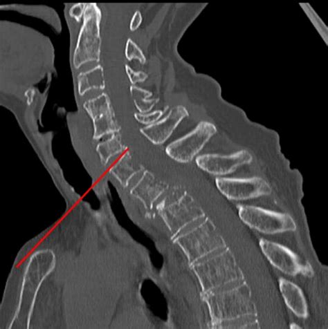 Anterior Surgical Approaches To The Cervicothoracic Junction When To