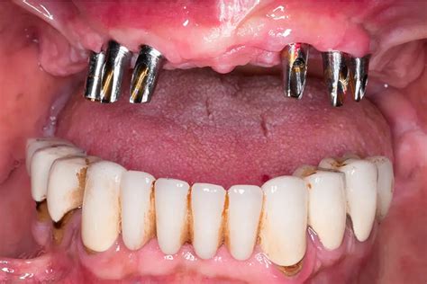 A Comprehensive Guide To Full Mouth Dental Implants Adhp