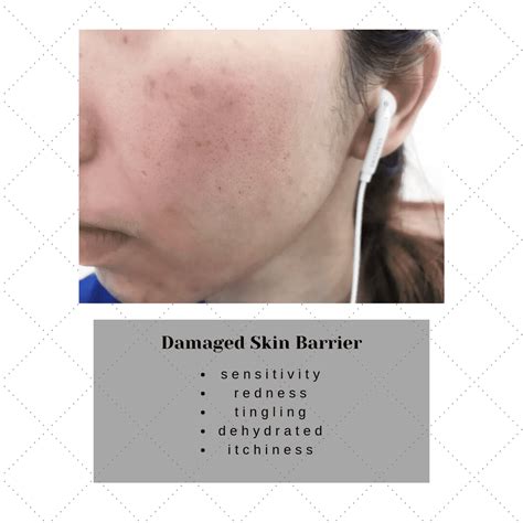 How to Repair a Damaged Skin Barrier - Dry Skin Advice