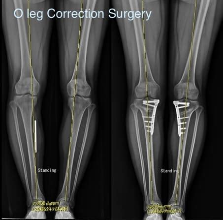 Bowleg Correction Surgery Before and After Photos | Dr. Chung