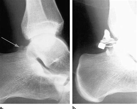 Posterior Impingement In A Professional Soccer Player A Control