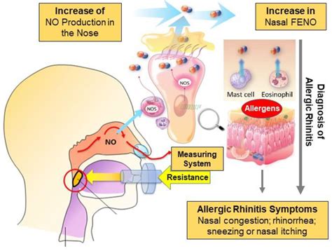 Allergic Rhinosinusitis And Airway Diseases