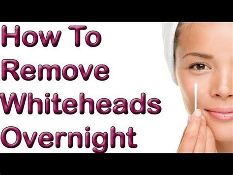 1 How To Remove Whiteheads Overnight 1 REMEDY To Remove Whitehead