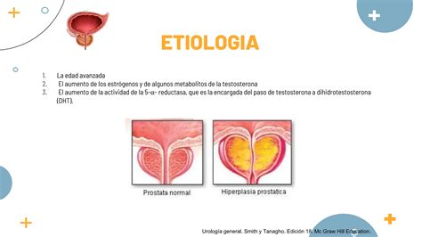 Hiperplasia Prost Tica Benigna Y C Ncer De Pr Stata Ppt