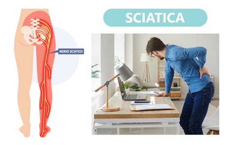 Fisioterapia Morrone Sciatica Cause E Rimedi