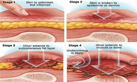 Stages Of Pressure Ulcers Pressure Ulcer Pressure Ulcer Staging Images