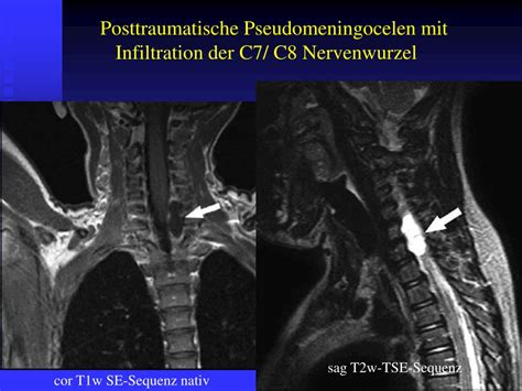 PPT MRT bei Plexus brachialis Läsionen PowerPoint Presentation free