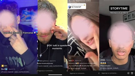 Cicatrice Francese Su Tik Tok Il Trend Del Tagliarsi Cos E Perch