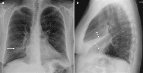 Atelectasis Chest X Ray