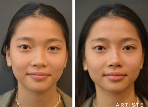 Asian Cosmetic Surgery Artiste Plastic Surgery