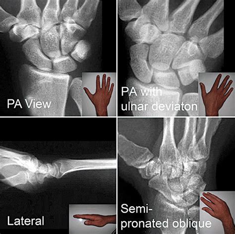 Standard recommended scaphoid x-ray views. Postero-anterior (PA), PA ...